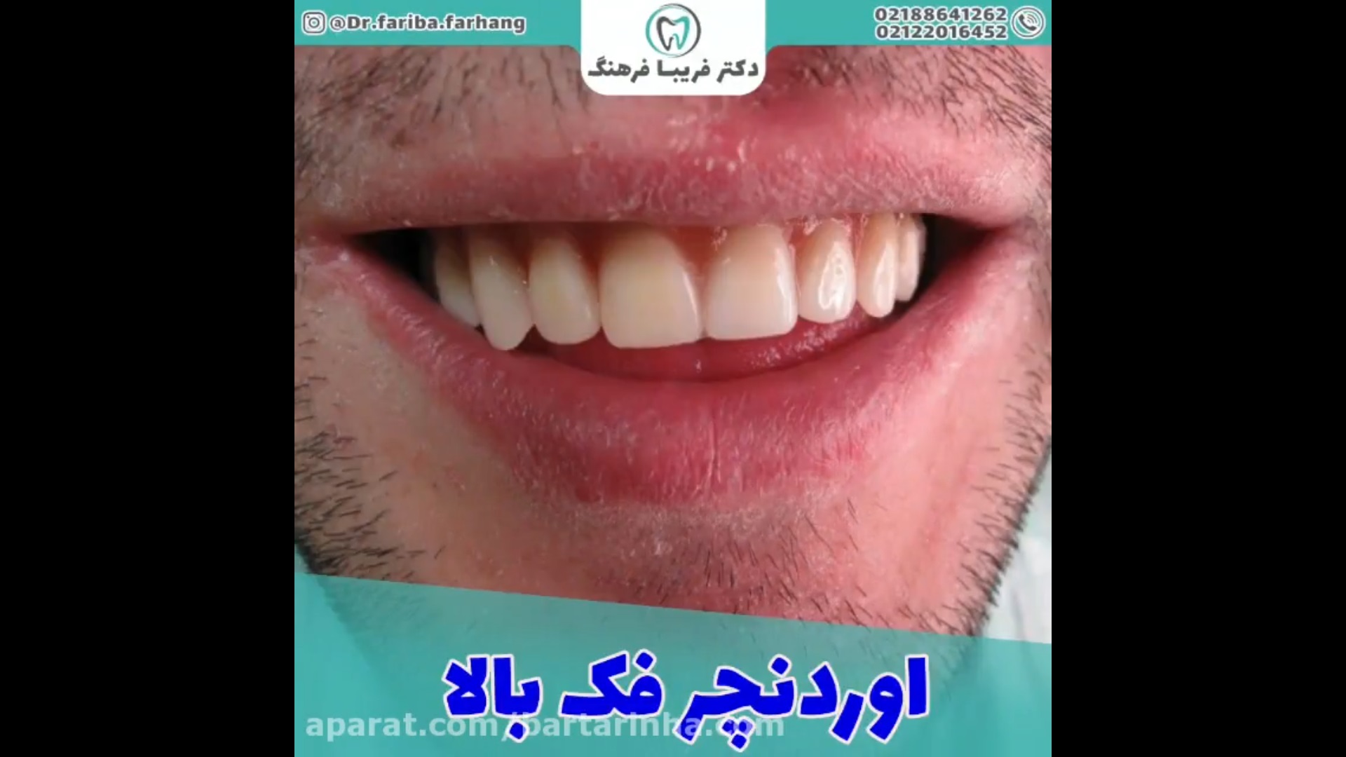 اوردنچر فک بالا