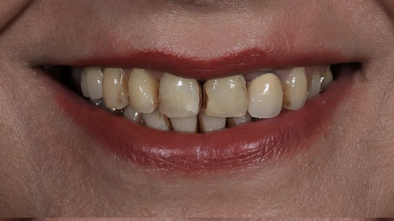 تصویر مراجعه کننده به مطب دکتر فریبا فرهنگ قبل از ترمیم