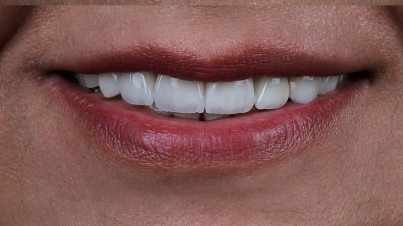 تصویر مراجعه کننده به مطب دکتر فریبا فرهنگ بعد از ترمیم